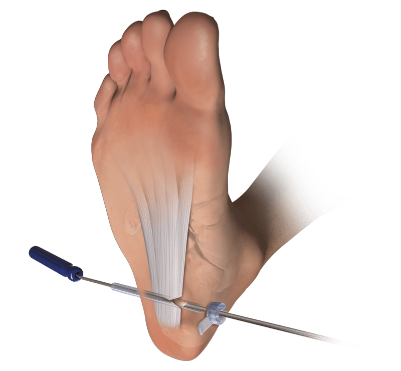 Endoskopische Plantarfaszienoperation