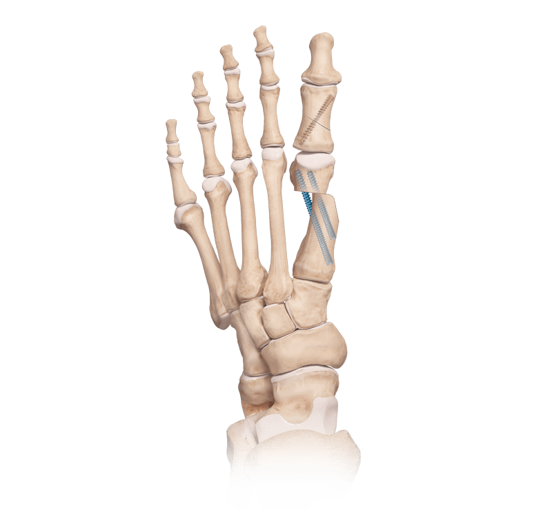 Osteotomia do primeiro metatarso