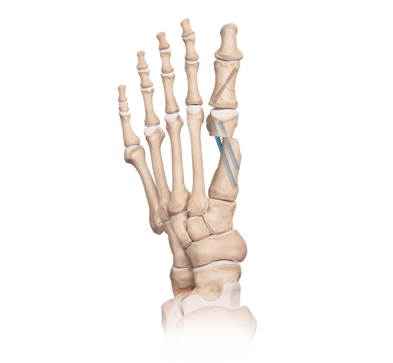 Osteotomía del primer metatarsiano