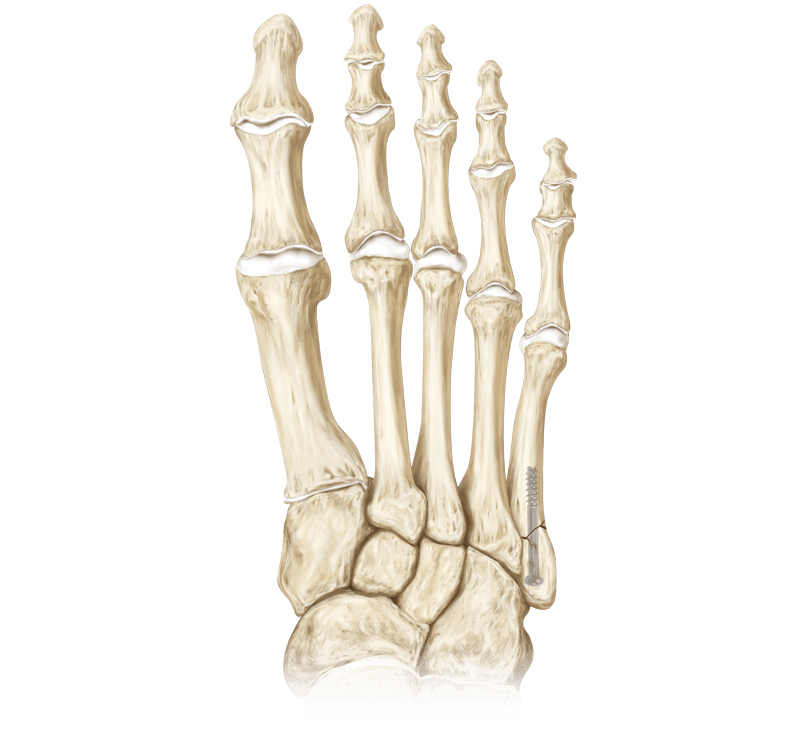 Forefoot Fractures