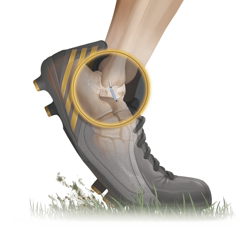 <em>Internal</em>Brace™ Technique for Brostrom Repair