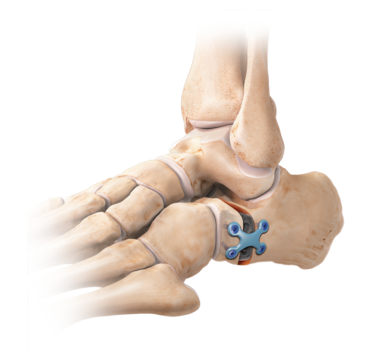 Alargamiento de la columna lateral (osteotomía de Evans)