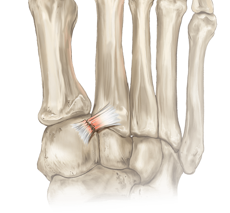 Dislocación de Lisfranc