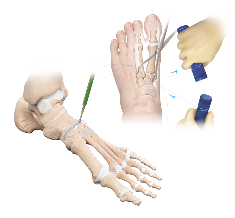 Fijación para lesiones de Lisfranc