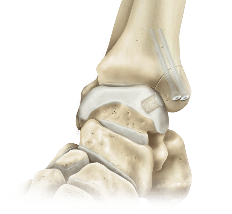 Osteotomie des Malleolus medialis