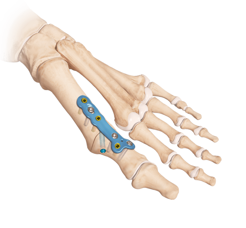 MTP Joint Arthrodesis