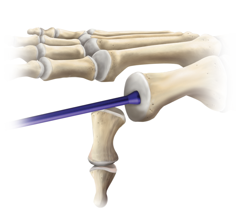 Osteochondrales Allotransplantat