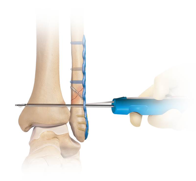 Syndesmosis Injury