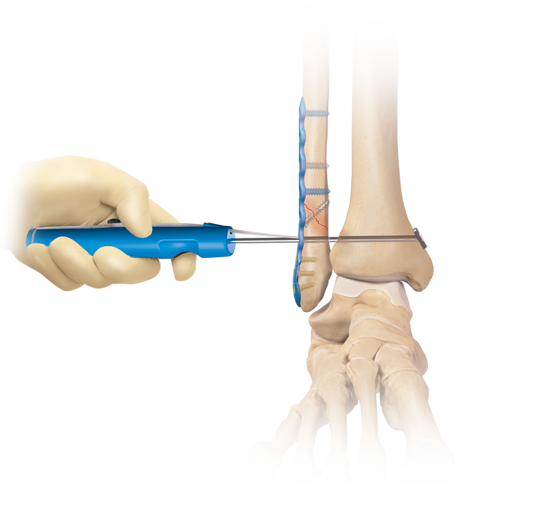 Reparación de sindesmosis