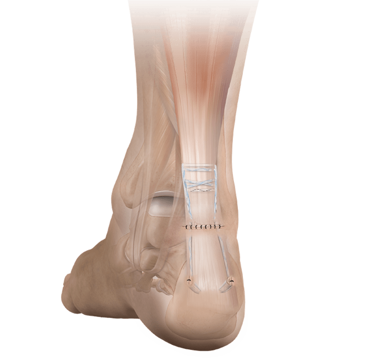 Sistema de implante Achilles Midsubstance SpeedBridge™