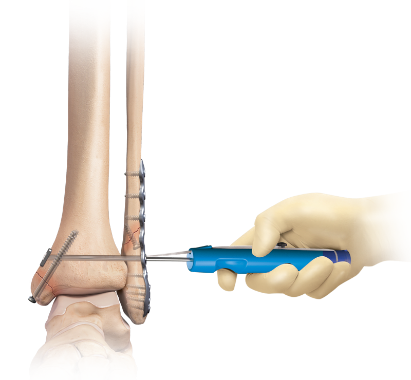 Ankle Fracture Management
 System