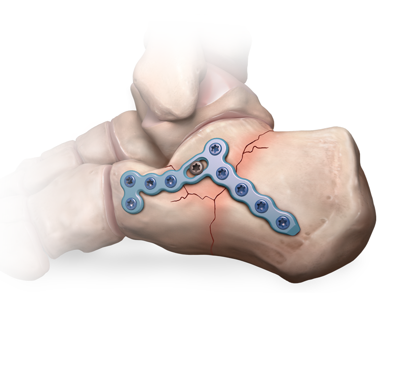 Sistema para fracturas del calcáneo