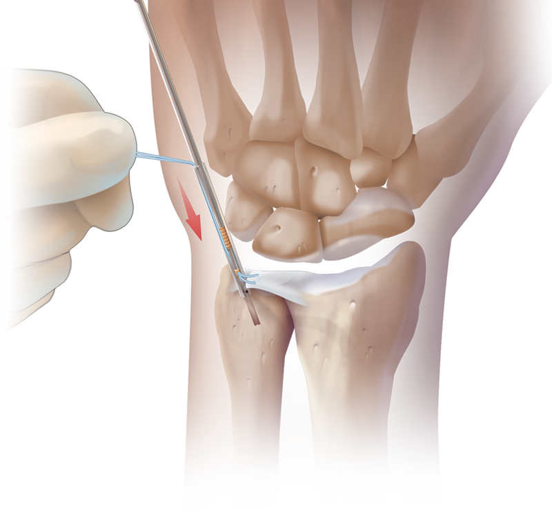 Reparación artroscópica sin nudos del CFCT usando PushLock<sup>®</sup>