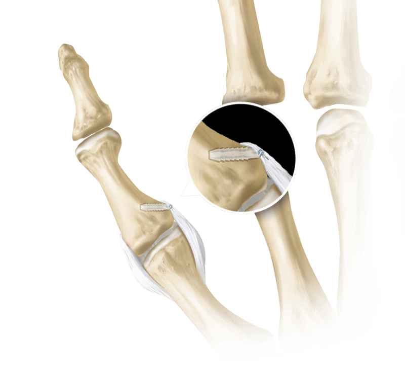 Reparación del ligamento colateral del pulgar con SutureTak<sup>®</sup>
