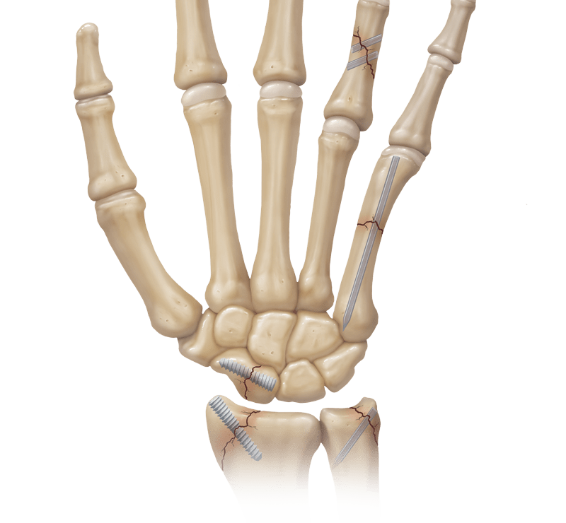 Fracture Management