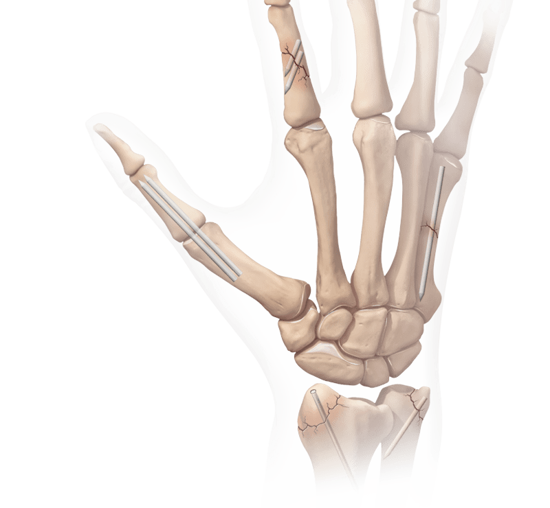 Osteoartritis