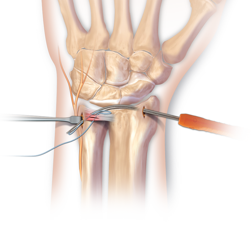 Arthroskopische Rekonstruktion des TFCC mit Micro SutureLasso™ (Inside-Out / Outside-In)