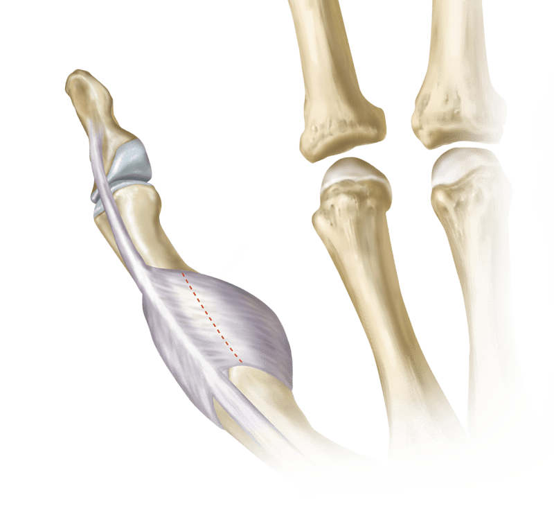 Desgarros del LCC y del URL del pulgar