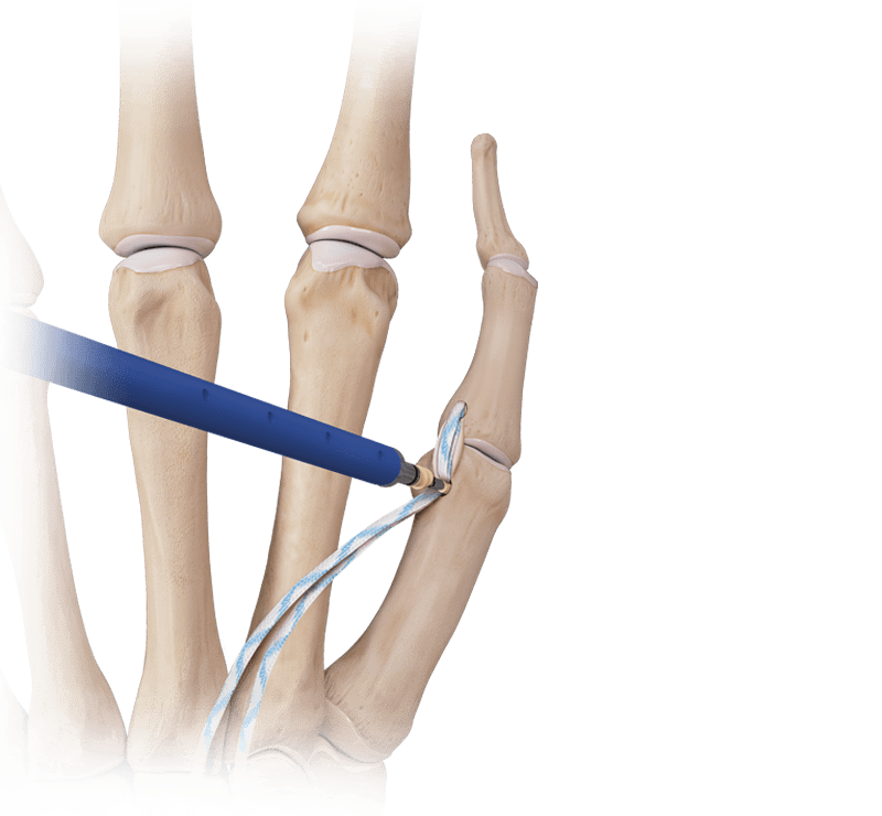 Aumentación en la reparación de ligamentos de mano y muñeca con <em>Internal</em>Brace™