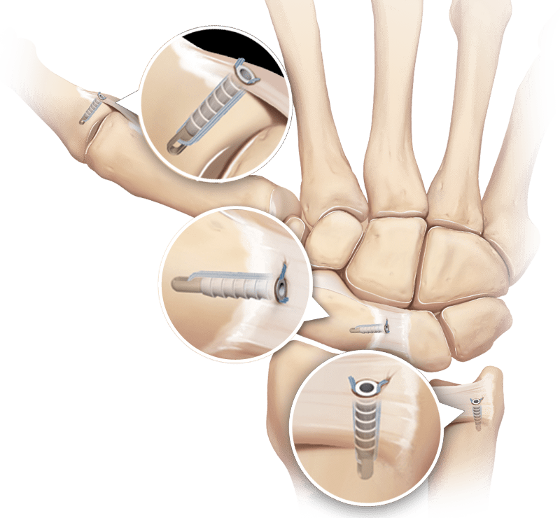 Soft Tissue Fixation Devices