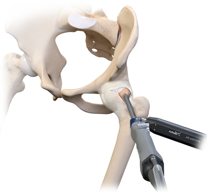 Impacto femoroacetabular