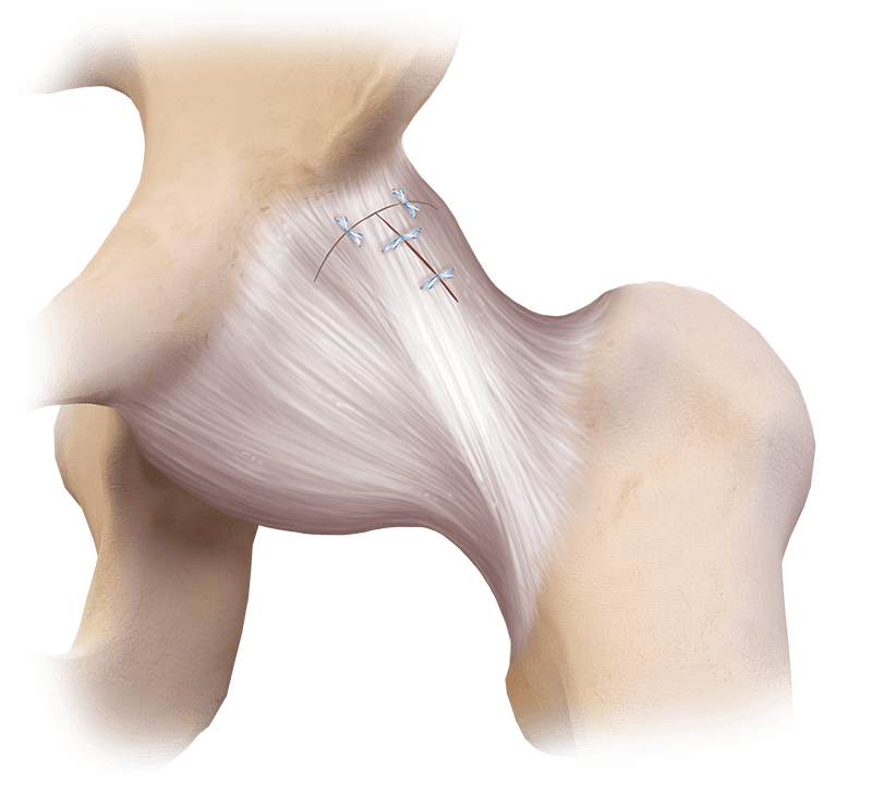 LoopLoc™ Knotless Implant