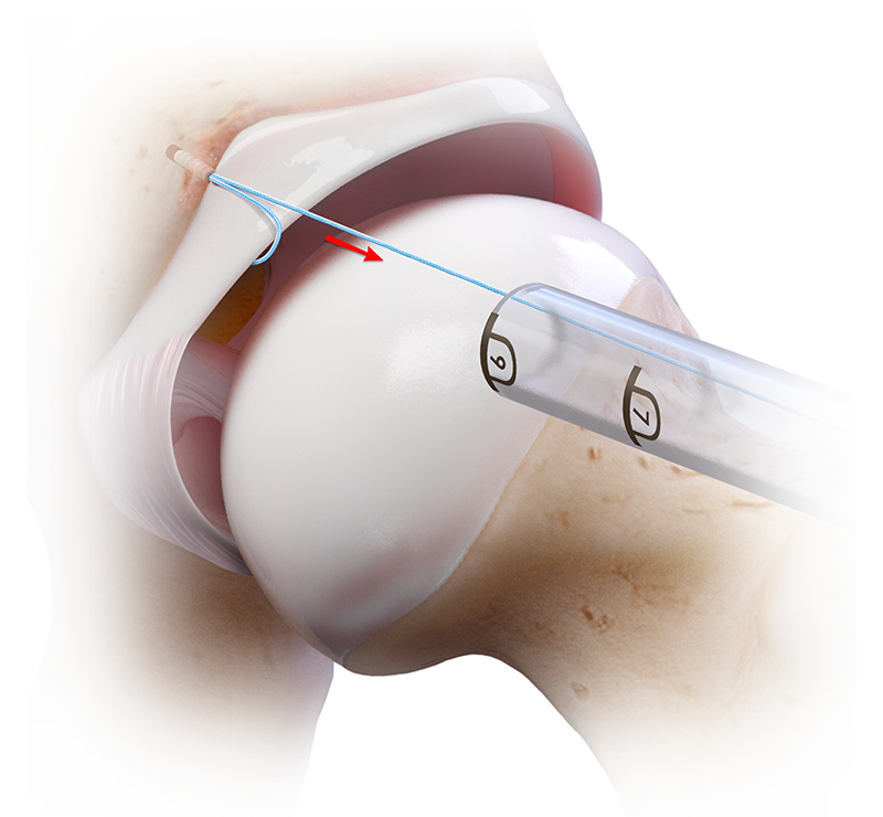 Labral Fixation