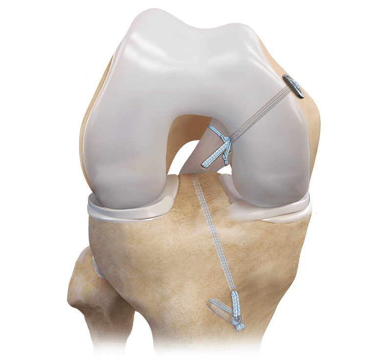 PCL Repair 