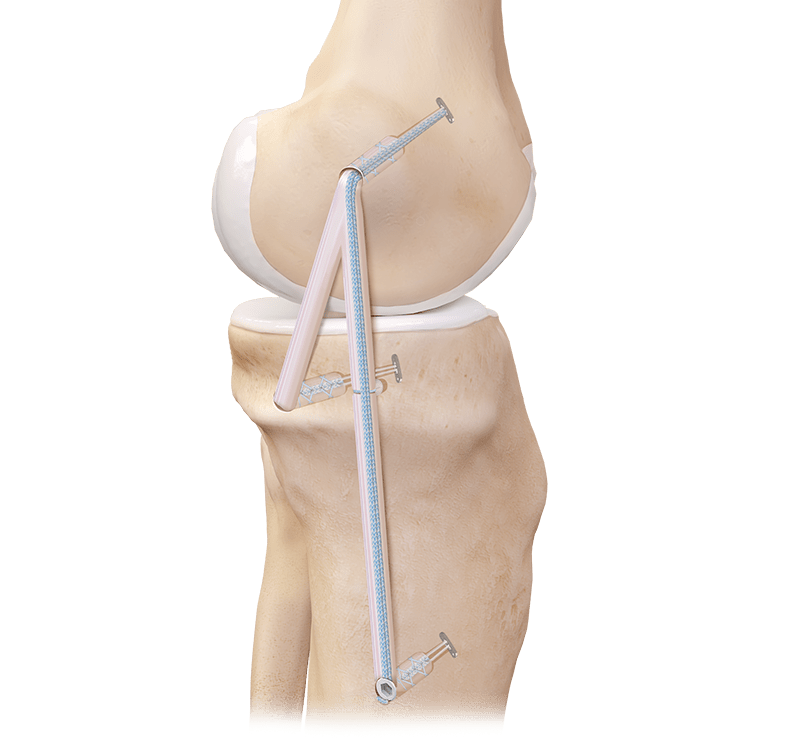 Arthrex - Medial Collateral Ligament (MCL) Reconstruction