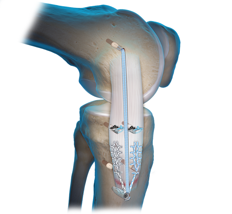 Medial Collateral Ligament (MCL) Repair 