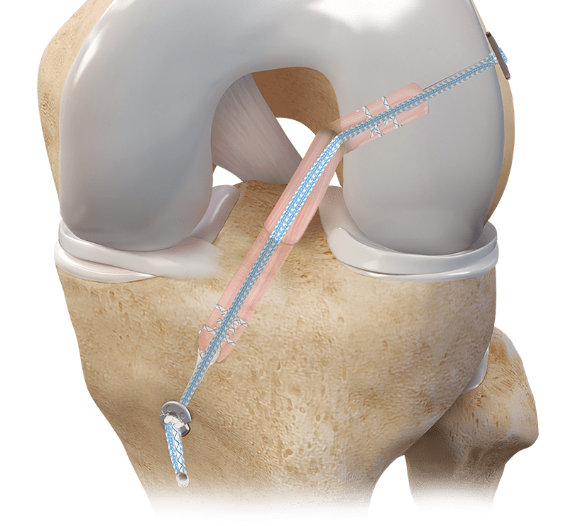 Autograft ACL-Rekonstruktion mit Hamstring