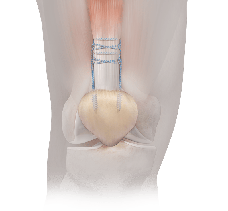 Tendon and Ligament Repair