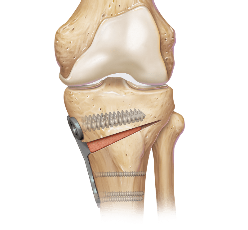 Tibial Opening Wedge