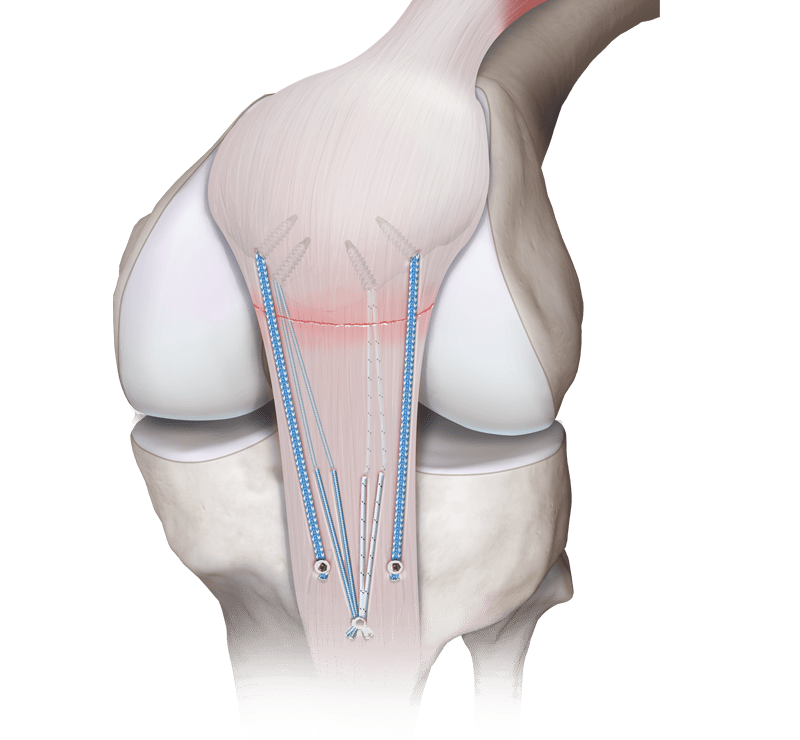 Patellasehnenrekonstruktion