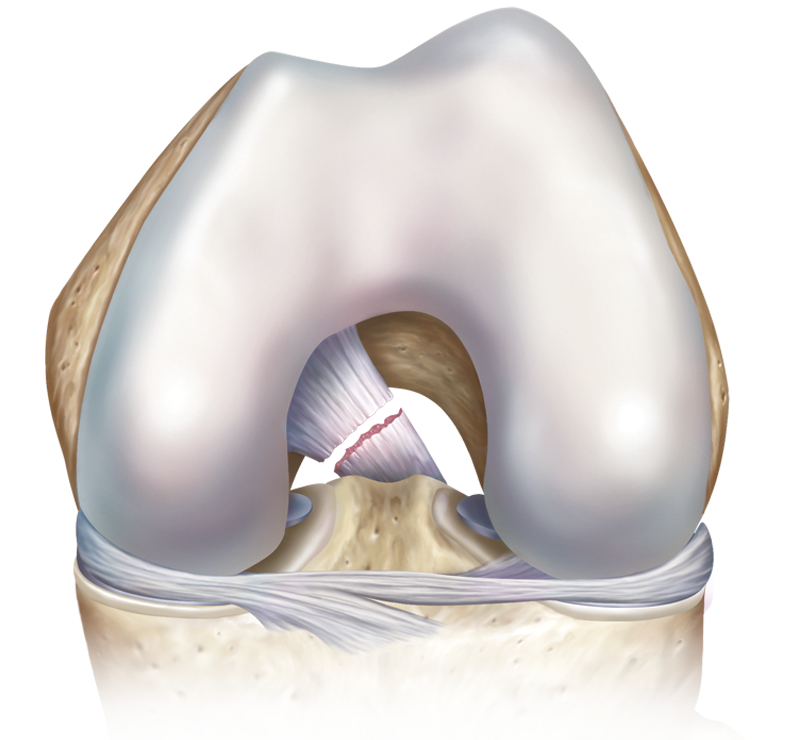 PCL Tear