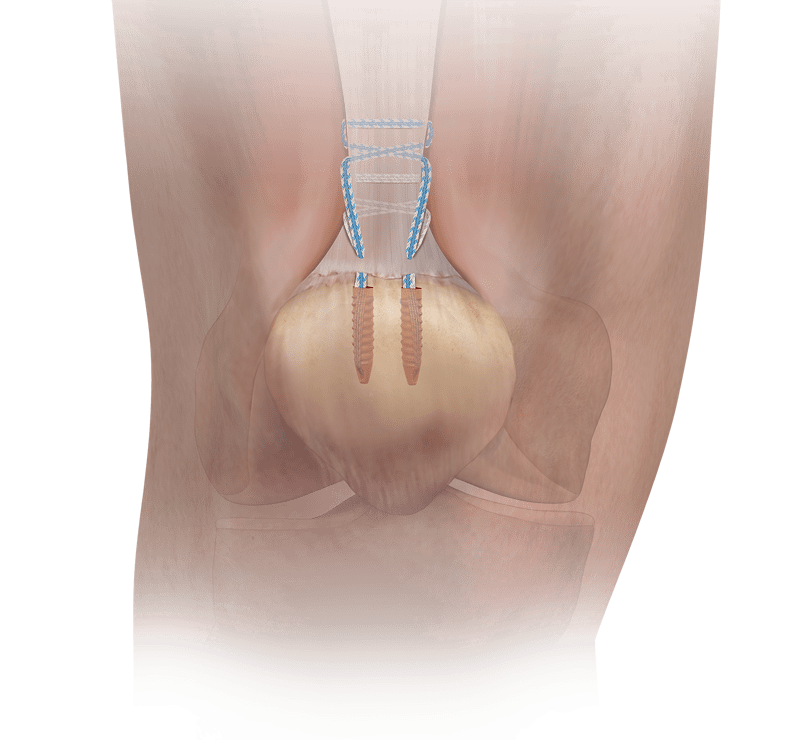 Reparación del tendón del cuádriceps con la técnica del sistema PARS