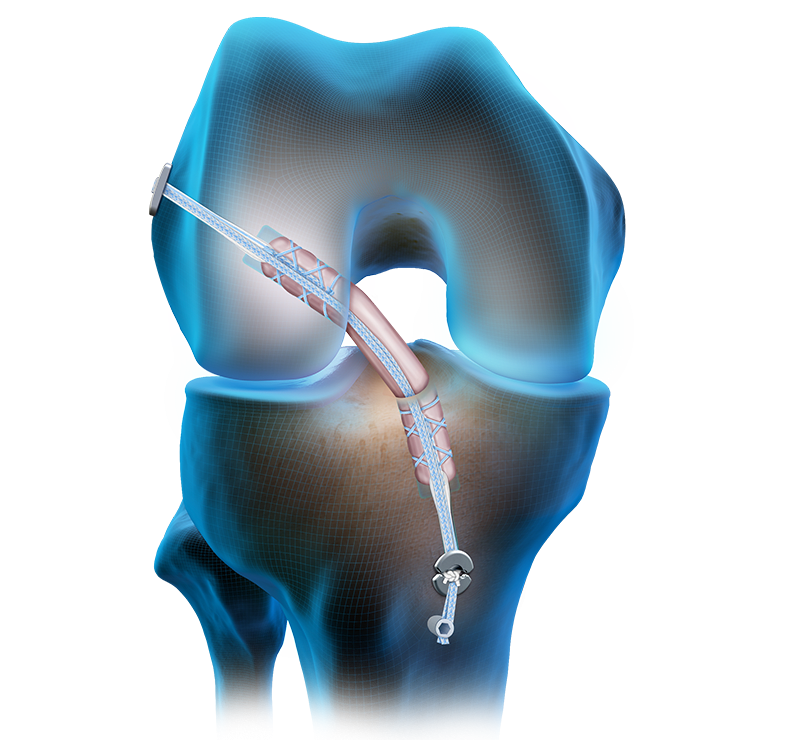 Suspensory Fixation