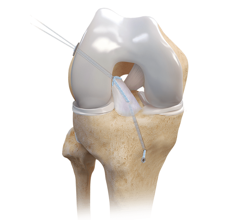 Repair TightRope® Implant With FiberRing™ Sutures