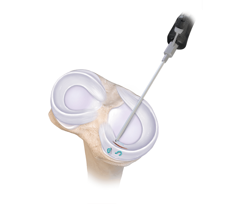 Meniscal Fixation and
 Transplant