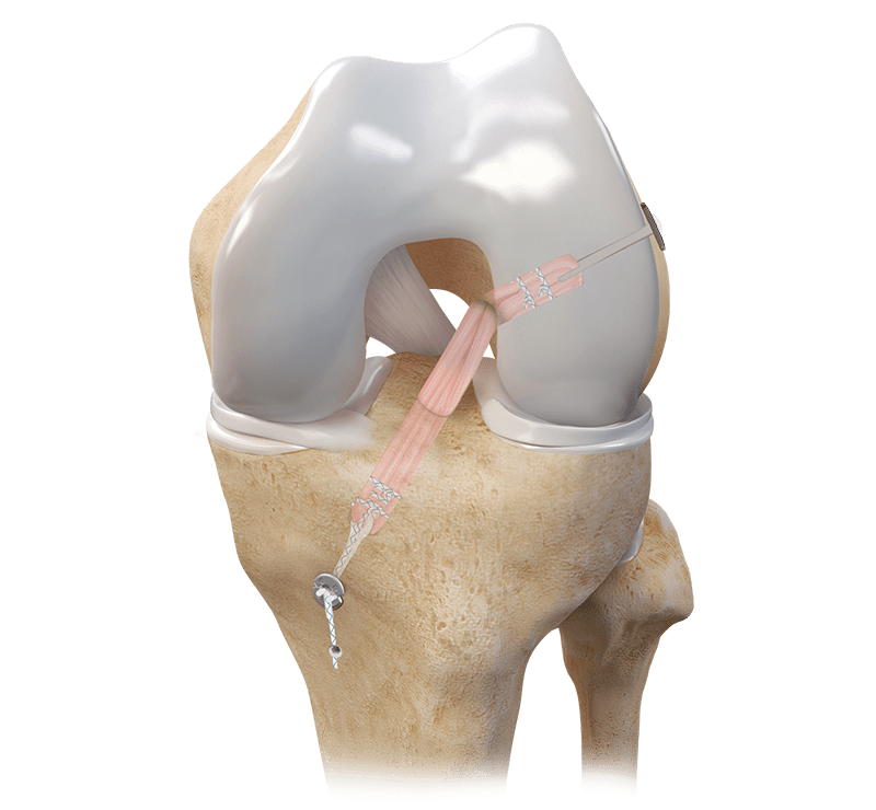 TightRope® II RT Implant