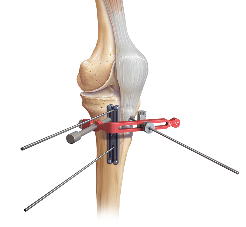 Sistema T3 AMZ para osteotomia da tuberosidade da tíbia