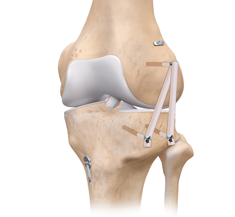 Anterolateral Ligament Augmentation