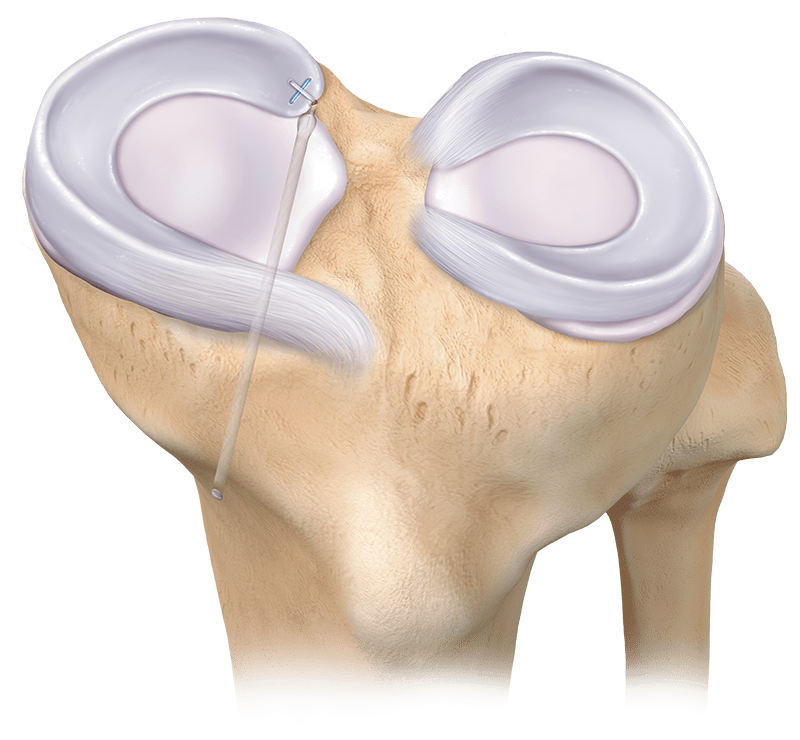 Reparo da raiz meniscal