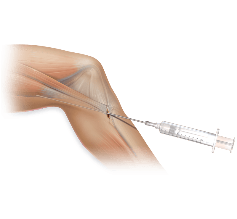 Hamstring Donor Site Delivery Tube