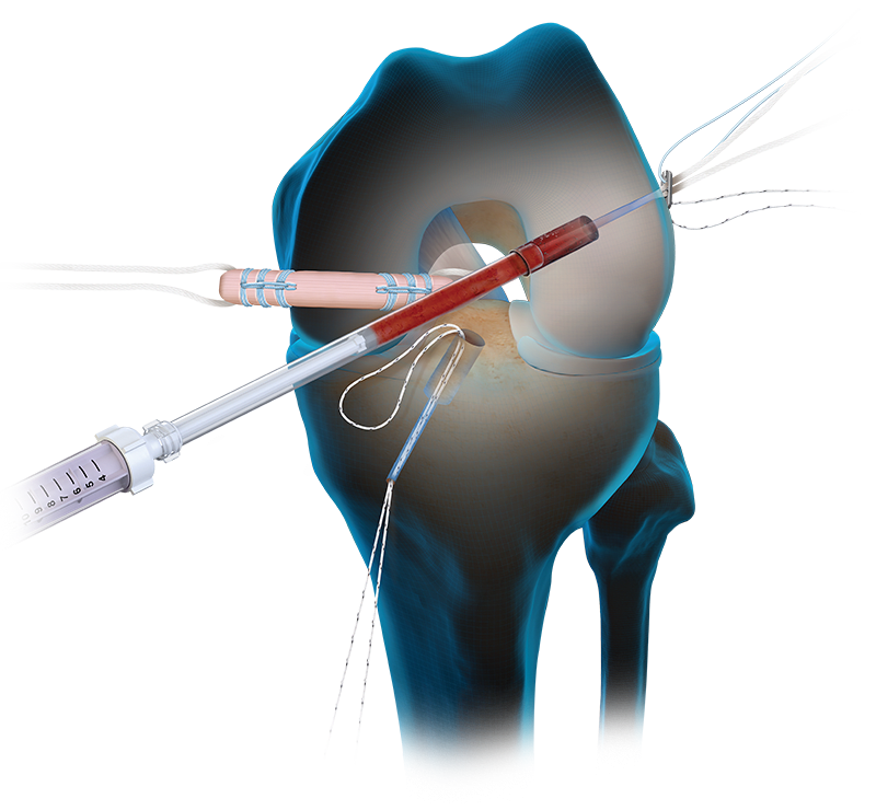 BioACL™ Technique