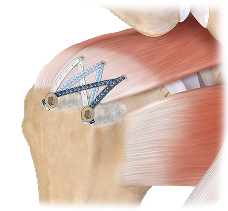 BoneSync™ Cement for Rotator Cuff Repair