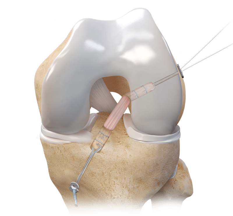 Allograft-Sehnen