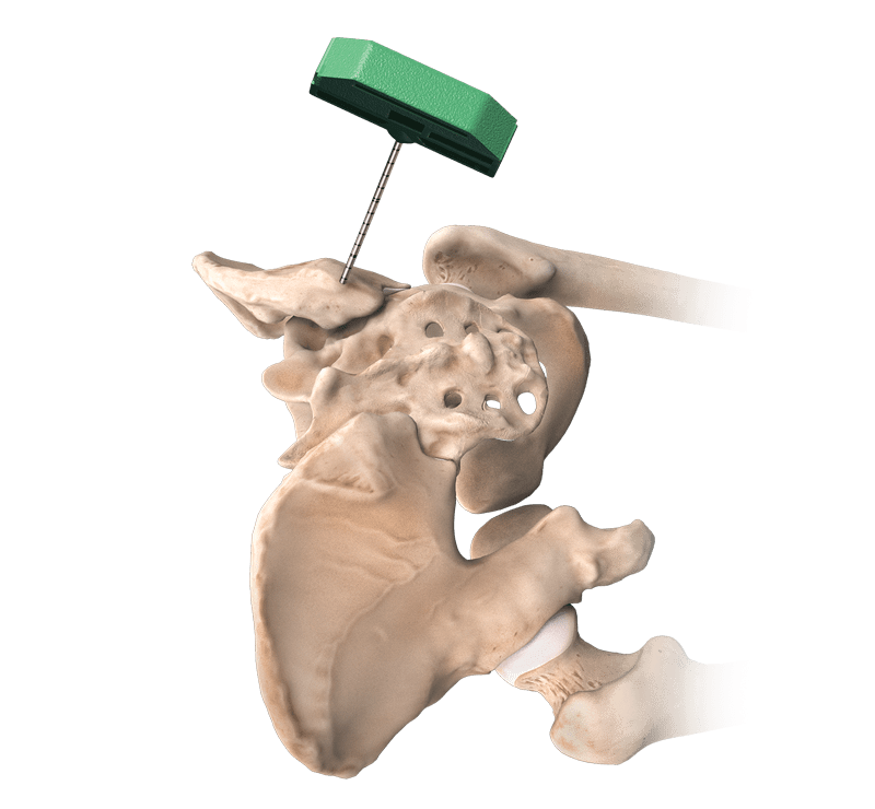 Angel<sup>®</sup> cPRP and Bone Marrow Processing System