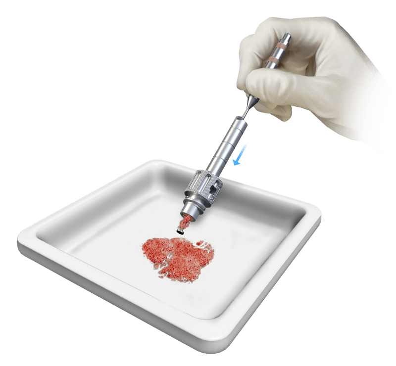 Arthrex - OsteoAuger™ Bone Graft Harvesting System