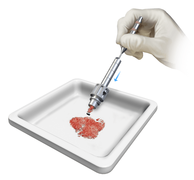 OsteoAuger™ Bone Graft Harvesting System